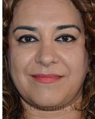 Ethnic Rhinoplasty Before & After Patient #6938