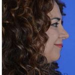 Ethnic Rhinoplasty Before & After Patient #6938