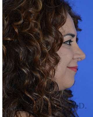 Ethnic Rhinoplasty Before & After Patient #6938
