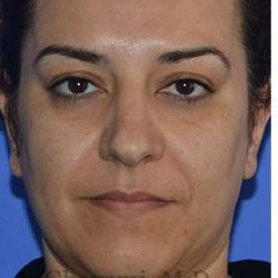 Ethnic Rhinoplasty Before & After Patient #6938