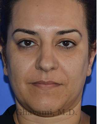 Ethnic Rhinoplasty Before & After Patient #6938