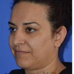 Ethnic Rhinoplasty Before & After Patient #6938