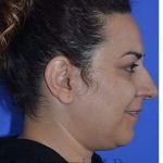 Ethnic Rhinoplasty Before & After Patient #6938