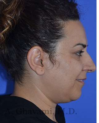 Ethnic Rhinoplasty Before & After Patient #6938