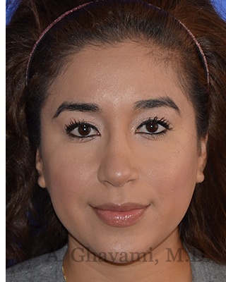Ethnic Rhinoplasty Before & After Patient #8247