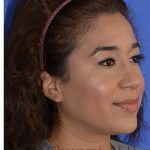 Ethnic Rhinoplasty Before & After Patient #8247