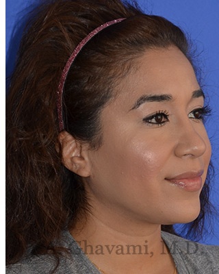 Ethnic Rhinoplasty Before & After Patient #8247