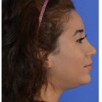 Ethnic Rhinoplasty Before & After Patient #8247