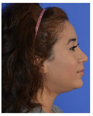 Ethnic Rhinoplasty Before & After Patient #8247