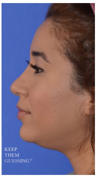 Ethnic Rhinoplasty Before & After Patient #8247