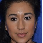Ethnic Rhinoplasty Before & After Patient #8247
