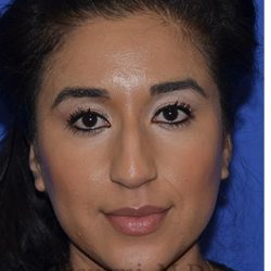 Ethnic Rhinoplasty Before & After Patient #8247
