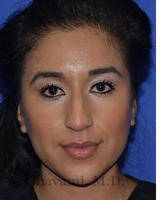Ethnic Rhinoplasty Before & After Patient #8247