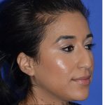 Ethnic Rhinoplasty Before & After Patient #8247
