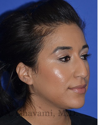 Ethnic Rhinoplasty Before & After Patient #8247