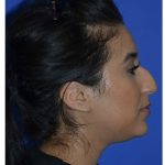 Ethnic Rhinoplasty Before & After Patient #8247