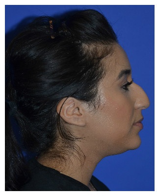 Ethnic Rhinoplasty Before & After Patient #8247