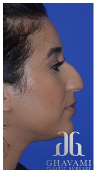 Ethnic Rhinoplasty Before & After Patient #8247