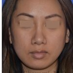 Ethnic Rhinoplasty Before & After Patient #8240