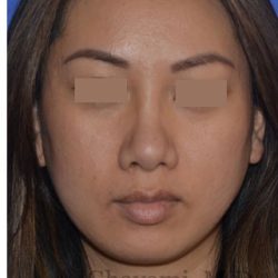 Ethnic Rhinoplasty Before & After Patient #8240