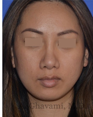 Ethnic Rhinoplasty Before & After Patient #8240