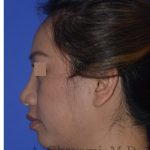 Ethnic Rhinoplasty Before & After Patient #8240