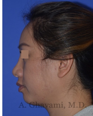 Ethnic Rhinoplasty Before & After Patient #8240