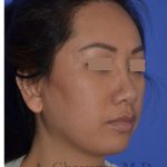 Ethnic Rhinoplasty Before & After Patient #8240