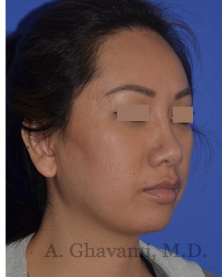 Ethnic Rhinoplasty Before & After Patient #8240