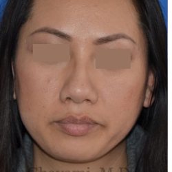 Ethnic Rhinoplasty Before & After Patient #8240