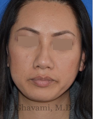 Ethnic Rhinoplasty Before & After Patient #8240