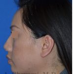 Ethnic Rhinoplasty Before & After Patient #8240