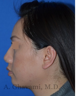 Ethnic Rhinoplasty Before & After Patient #8240