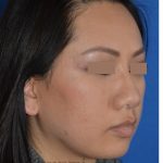 Ethnic Rhinoplasty Before & After Patient #8240