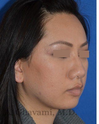 Ethnic Rhinoplasty Before & After Patient #8240