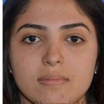Ethnic Rhinoplasty Before & After Patient #6926
