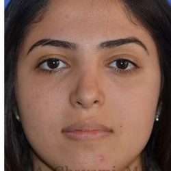 Ethnic Rhinoplasty Before & After Patient #6926
