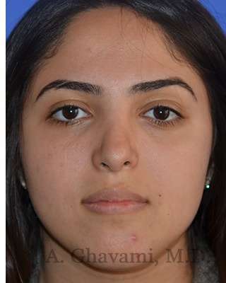 Ethnic Rhinoplasty Before & After Patient #6926