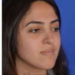 Ethnic Rhinoplasty Before & After Patient #6926