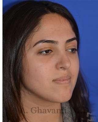 Ethnic Rhinoplasty Before & After Patient #6926