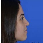 Ethnic Rhinoplasty Before & After Patient #6926
