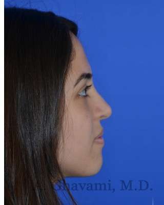 Ethnic Rhinoplasty Before & After Patient #6926