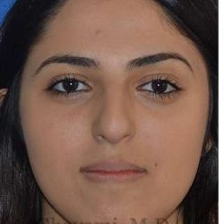 Ethnic Rhinoplasty Before & After Patient #6926