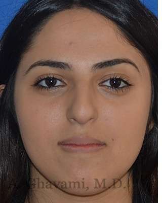 Ethnic Rhinoplasty Before & After Patient #6926