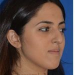 Ethnic Rhinoplasty Before & After Patient #6926
