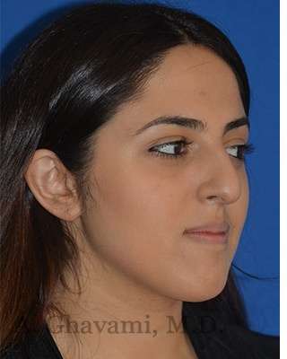 Ethnic Rhinoplasty Before & After Patient #6926