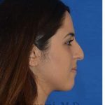 Ethnic Rhinoplasty Before & After Patient #6926