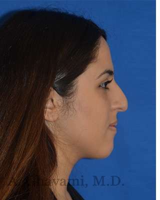 Ethnic Rhinoplasty Before & After Patient #6926