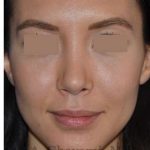 Rhinoplasty Before & After Patient #6919