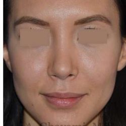 Rhinoplasty Before & After Patient #6919
